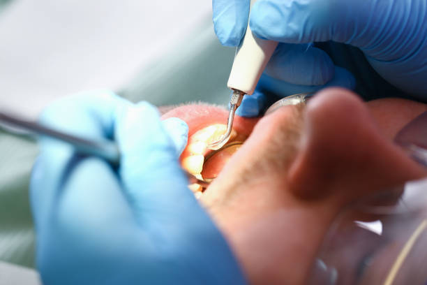 Best Emergency Treatment for Dental Infections or Abscesses in Aspinwall, PA