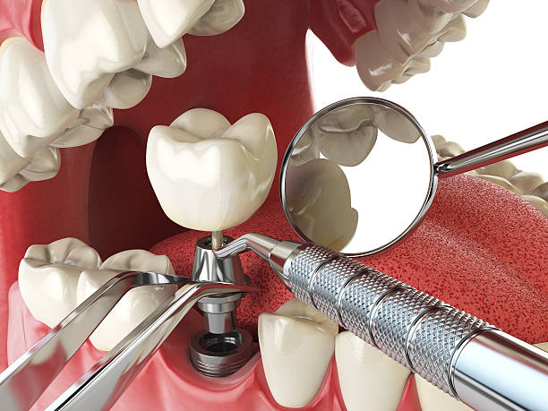Best Emergency Dental Care for Broken or Chipped Teeth in Aspinwall, PA